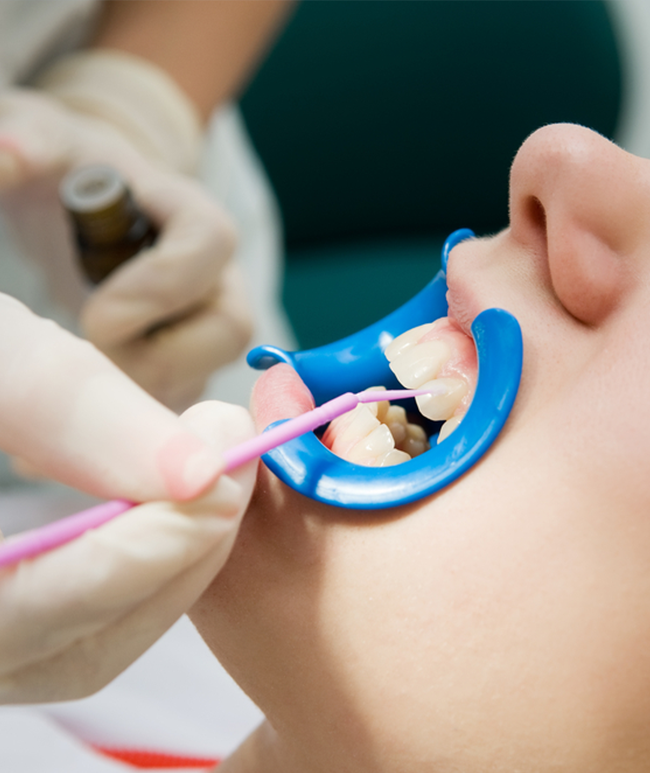 Fluoride-Dental-Sealant